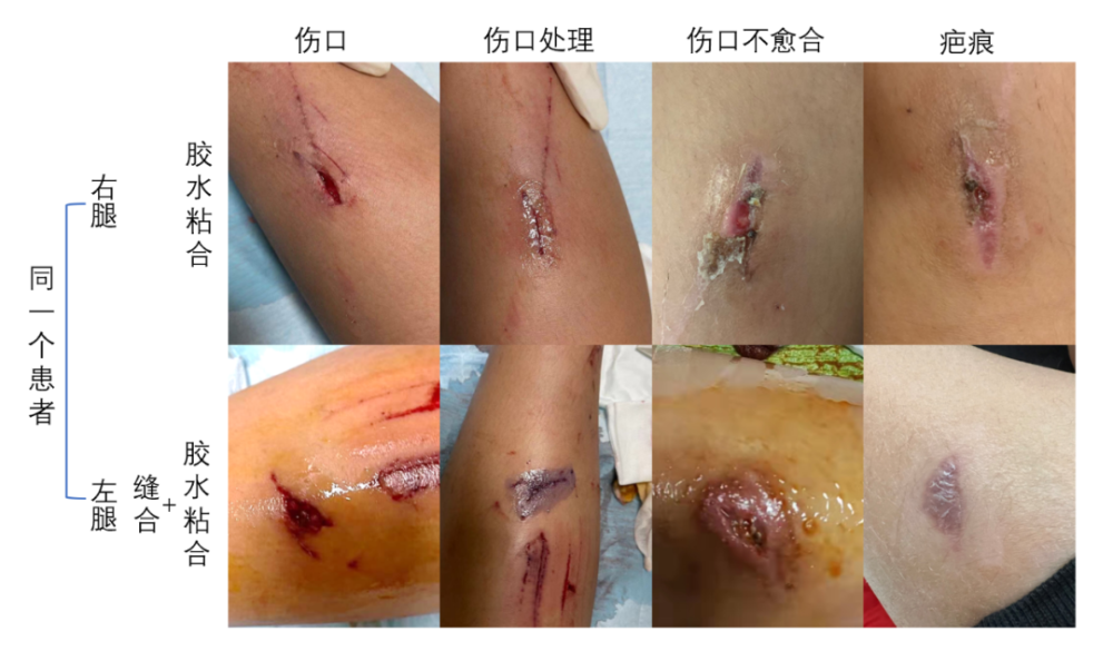 这些伤口不用缝用胶水一涂就好