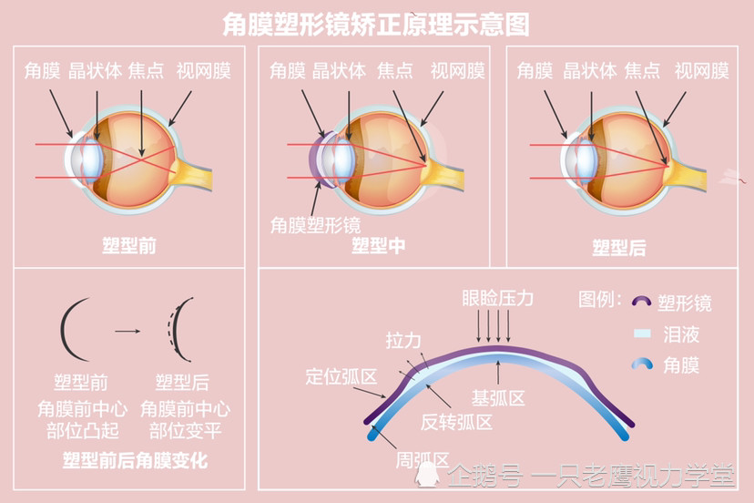 二:角膜塑形原理:正常角膜前面曲率半径7.8毫米,后面曲率半径6.8毫米.