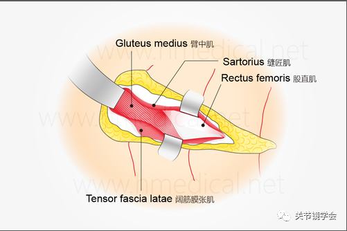 牵开阔筋膜张肌和缝匠肌即可显露髋关节深部的两块肌肉:股直机和臂