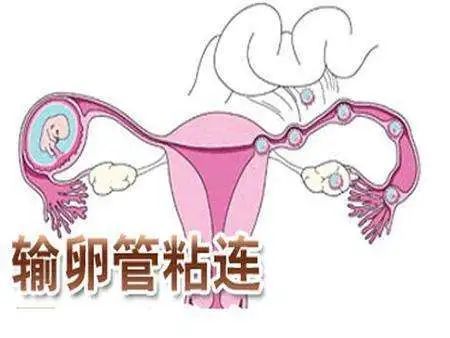输卵管粘连是怎么引起的该如何诊断