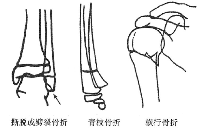 撕脱或劈裂骨折;螺旋形骨折青枝骨折嵌入骨折;纵行骨折;疲劳骨折粉碎