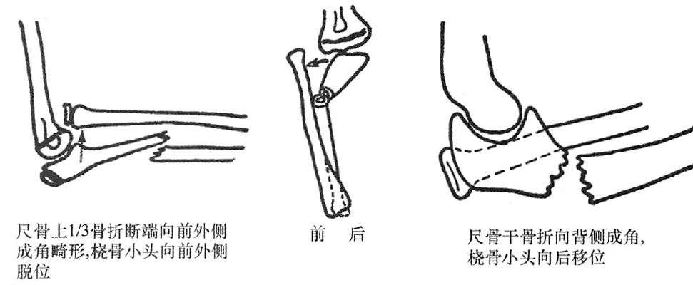 四肢骨折的分型丨上肢骨折及脱位