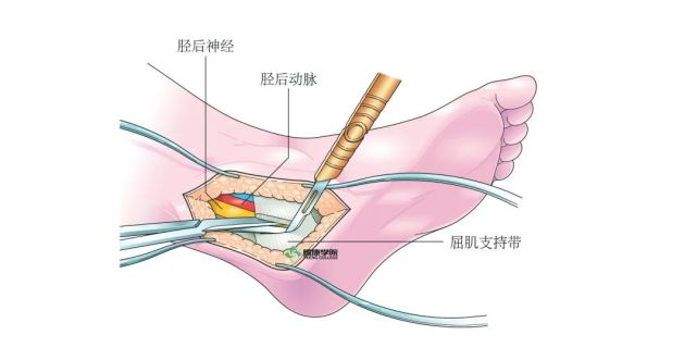 胫神经解剖及临床检查