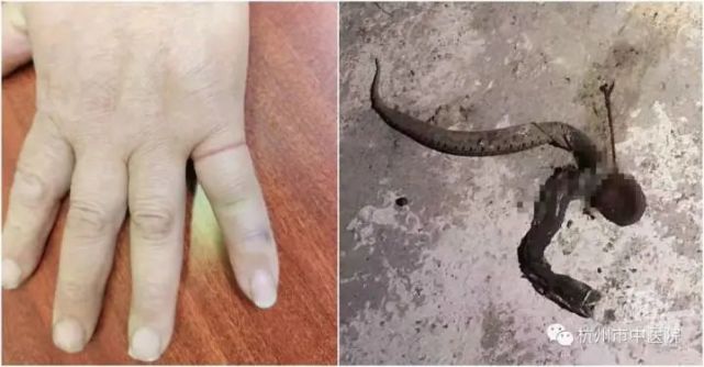 天热了,杭州市中医院接诊今年第一例蛇咬伤患者