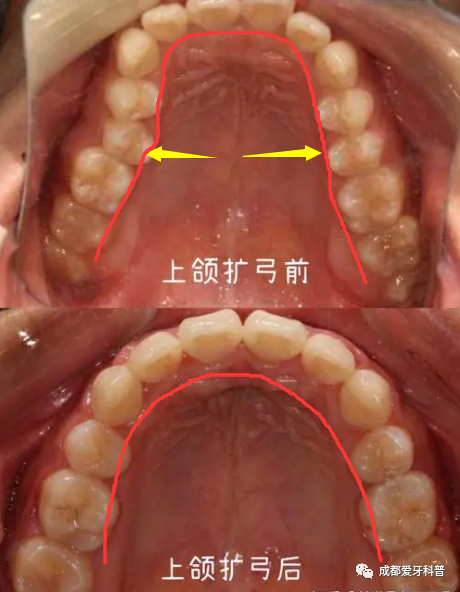 任欢医生讲:牙齿扩弓会让脸型变大变宽吗?