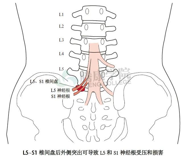 千查万别腰骶椎特殊检查