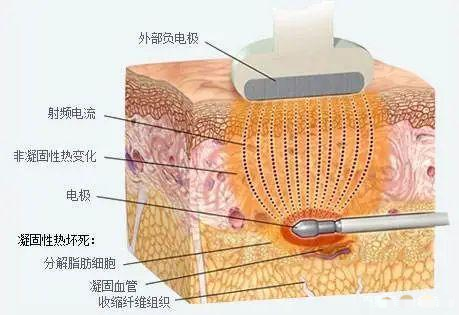 西安美莱负压吸脂水动力吸脂射频溶脂冷冻溶脂是什么