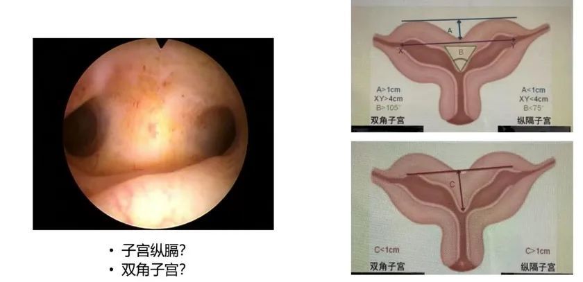 每周一课第9期精彩分享马德美教授子宫纵隔的诊治策略