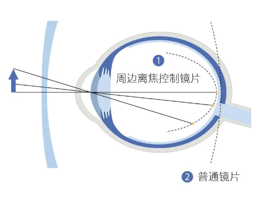 针对不同近视风险的青少年,蔡司推出蔡司成长乐镜片系列,将"周边视力