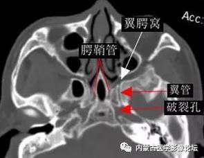 面)(腭鞘管层面)(翼上颌裂层面)(翼腭管,腭大/小管层面)翼腭窝ct显示