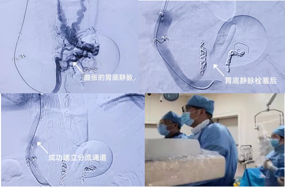 为患者架起生命之桥哈医大四院介入血管外科成功救治肝硬化大呕血患者