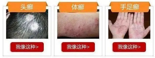 注意这些皮肤病的传染方式你知道吗