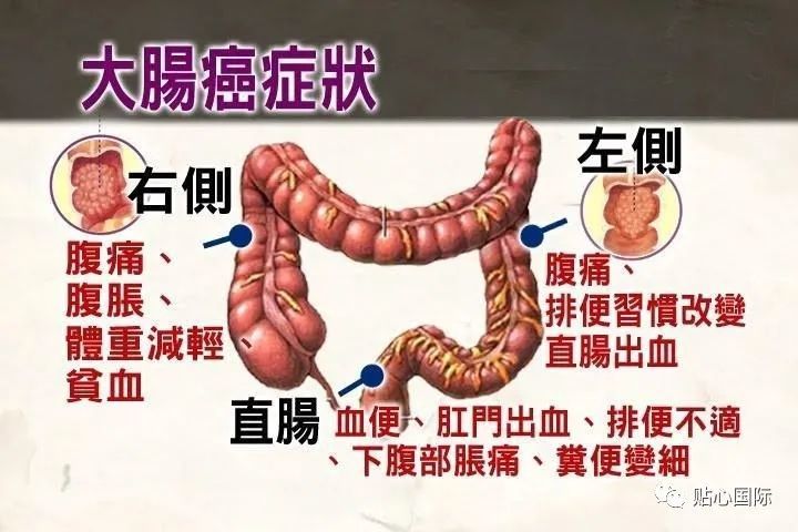 贴心医生直肠癌有什么明显的症状吗