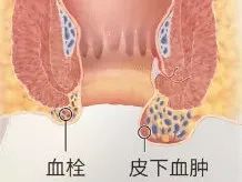 痔疮|血栓性外痔|肛门|肉疙瘩