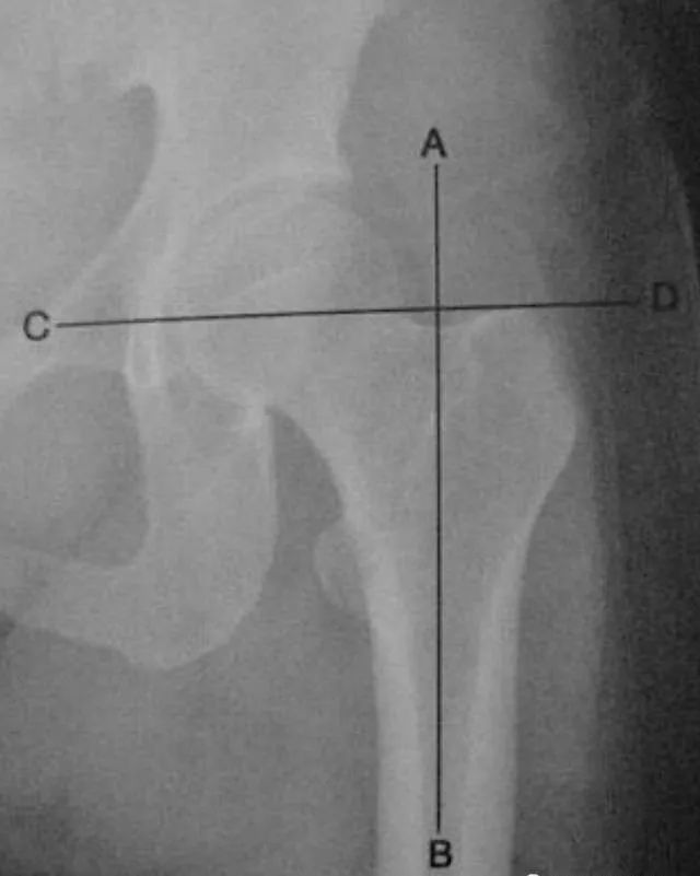骨科精读髋关节的x线解剖及应用技巧最全总结