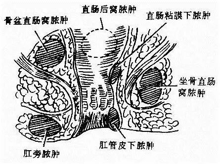 肛门疼痛原因多对照看看你属于哪一种