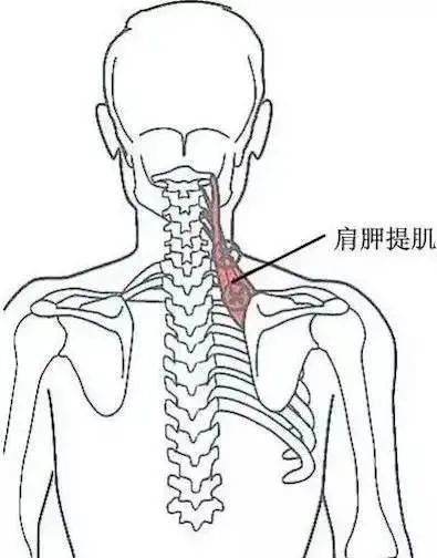 此肩胛骨内角压痛点按压时可感疼痛放射至同侧颈项,前额,甚至颈部,有