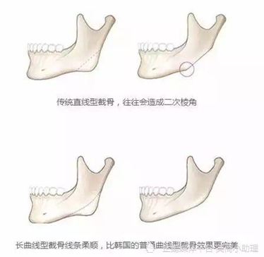 北京圣嘉新张立天下颌角截骨的几种方式和适合人群