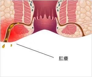 不可忽视的肛门潮湿