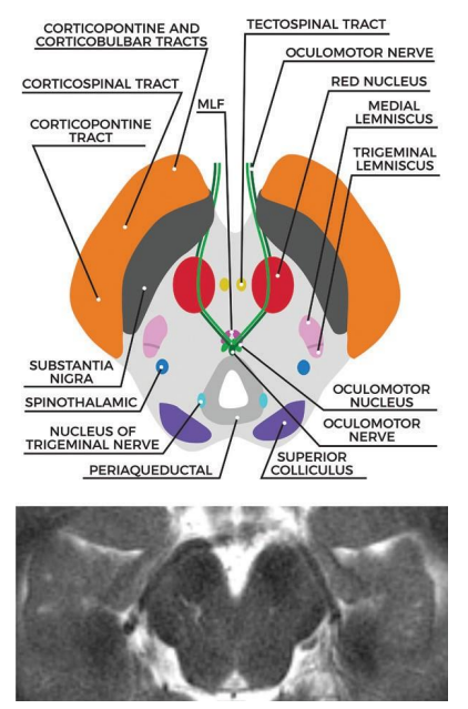 tegmentum被盖,substantia nigra黑质,red nucleus红核,cn3动眼神经核