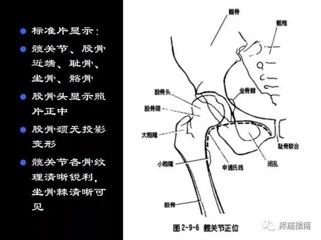 正位线片上,因髋臼三骨之间以"y"形软骨相连,融合之前,表现为横行带状