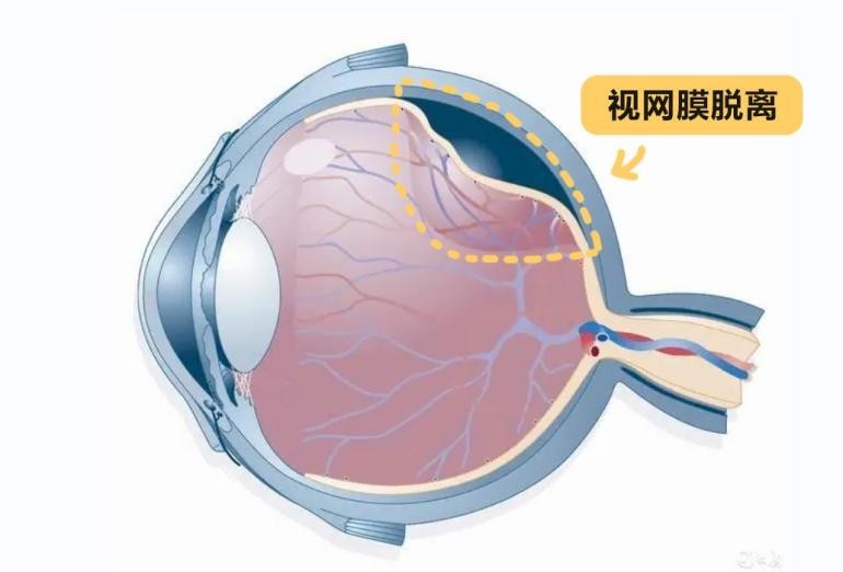 篮球撞眼致13岁男孩双眼视网膜脱离