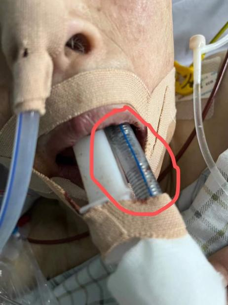 气管插管患者血氧维持不住?试试这种固定方法!