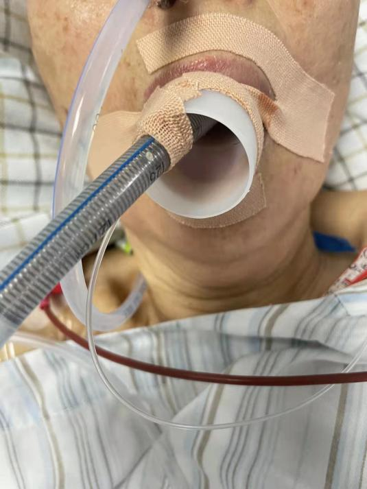 气管插管患者血氧维持不住试试这种固定方法