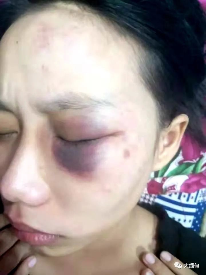 缅甸仰光一名女青年坐出租车被打成熊猫眼手机和钱包还被抢走