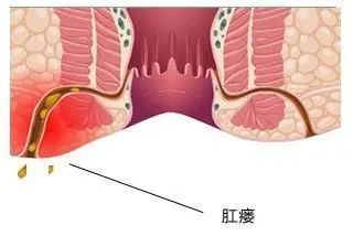 医生我的肛周脓肿能不开刀吗