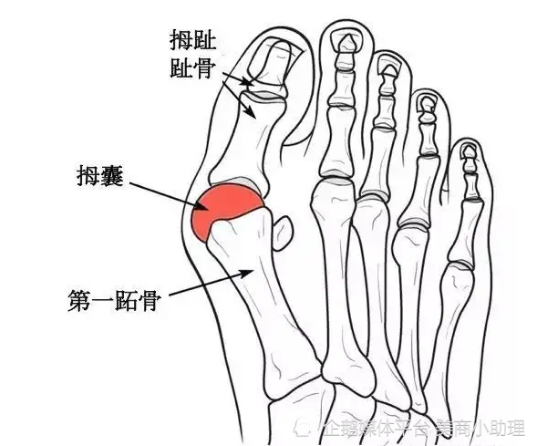 大脚骨医生苏敬达介绍:大脚骨在医学上称为"拇外翻",是足踝疾病中比较