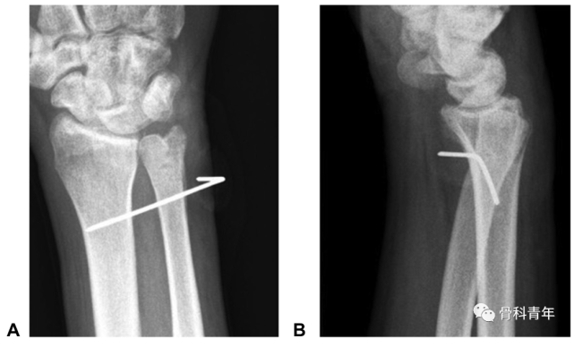 下尺桡关节脱位(distal radioulnar joint dislocation)