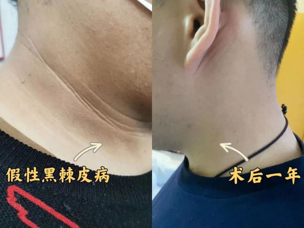 减重案例脖子越洗越黑原来是黑棘皮症