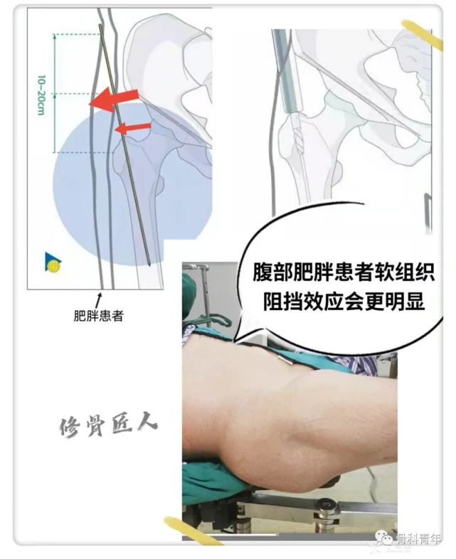 骨科精读|实战经验:髓内钉固定治疗股骨转子间骨折10条推荐!