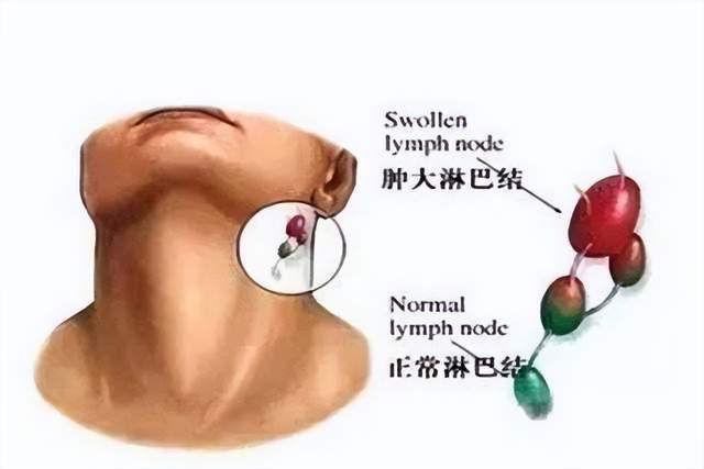 泰美宝法肿瘤医院健康资讯淋巴结肿大意味着什么