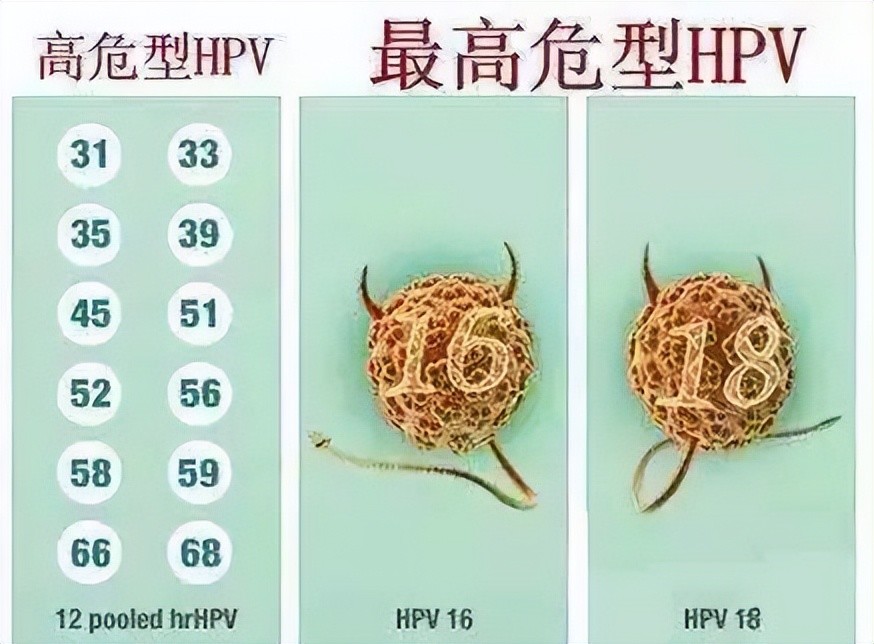 感染了hpv一定会得宫颈癌吗