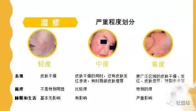 SEO十万个为什么会长湿疹 腾讯网