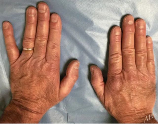 瓦滕贝格征(wartenberg sign)患者前臂伸肘,检查者叩击肘部,检查有无