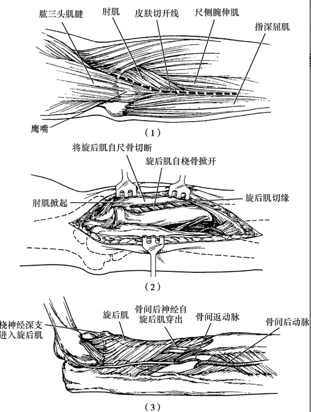 骨科小技巧尺骨上13及桡骨上14后外侧显露径路byod径路