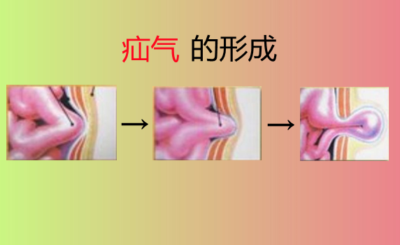 疝气也会欺负人偏爱老和少