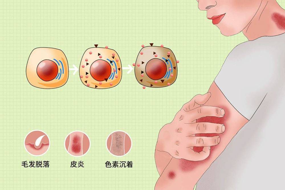 帝肤露带你了解如何预防放疗时的皮肤损伤