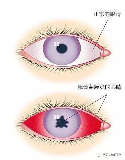 这种"红眼病"延误诊治可致盲