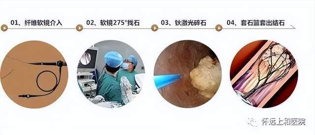 上和技术谈指尖上的艺术钬激光碎石取石术