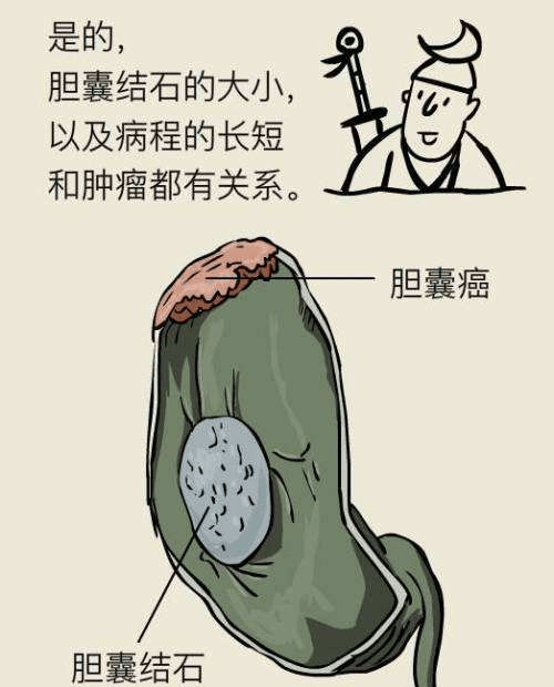 得了胆结石的症状有哪些一文带你了解胆结石的前世今生