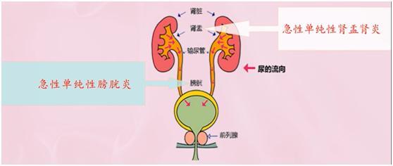 单纯性泌尿系感染的病因及发病机制