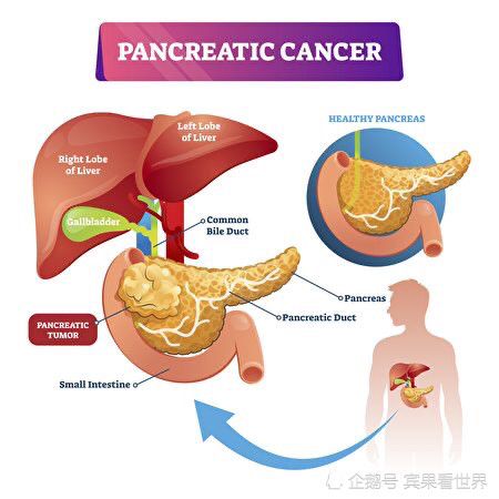 新筛查方法可查出95一期胰腺癌