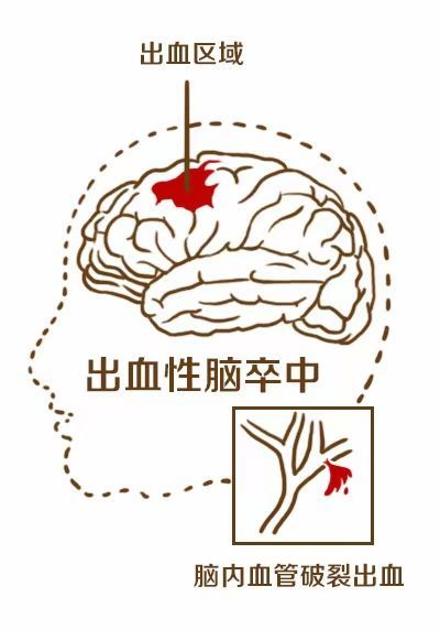 脑卒中发病率流行病学调查