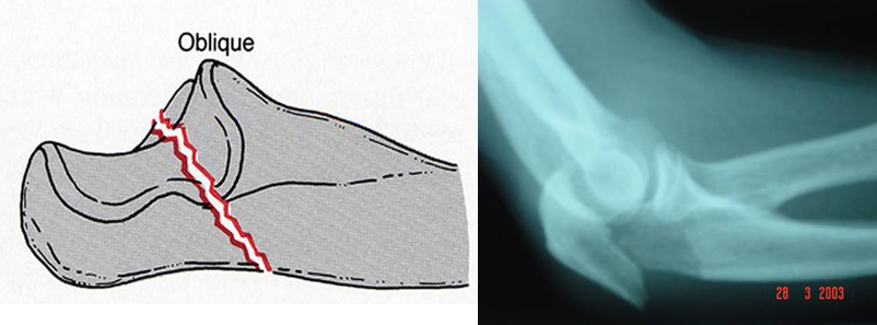从前方皮质穿出平行穿克氏针解剖复位尺骨鹰嘴骨折张力带固定技术f