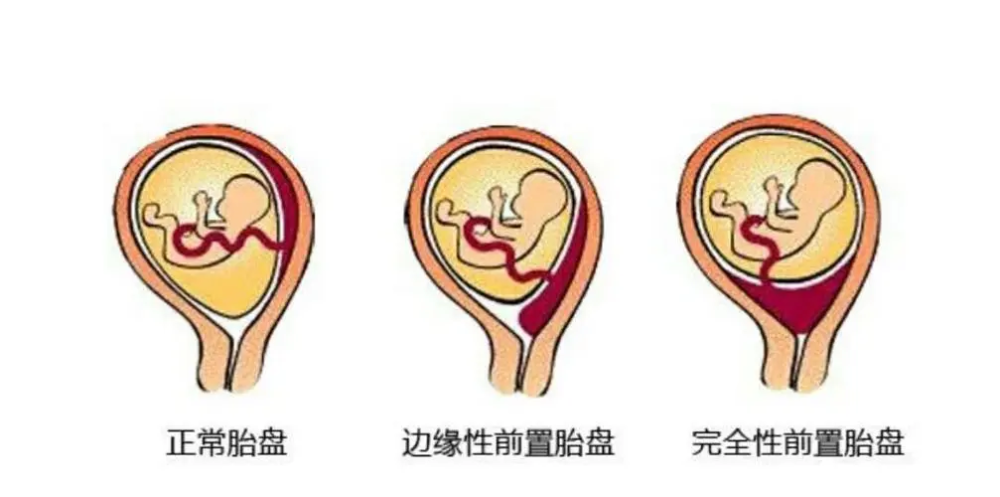 贝安健康前置胎盘怀孕时有哪些需要注意事项