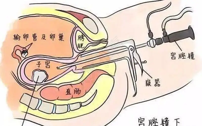 应该怎么样治疗宫腔粘连